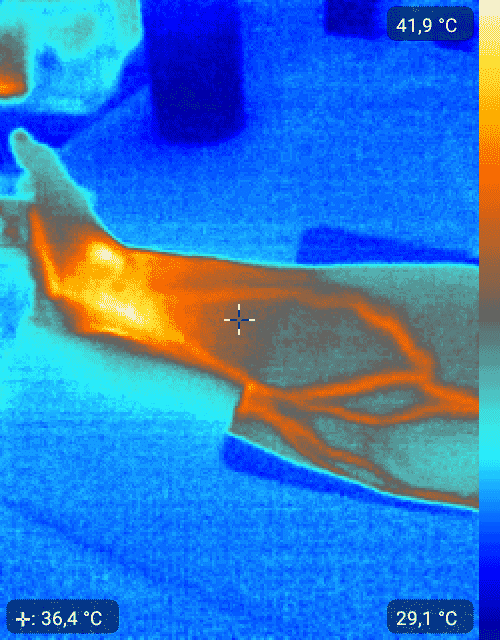 IMAGEN-BRAZO-ZALIENTE-DIATERMIA