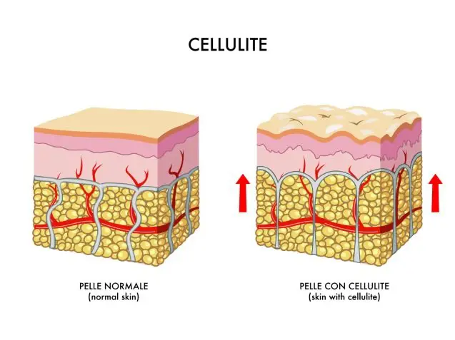 ARTICULO-CELULITIS